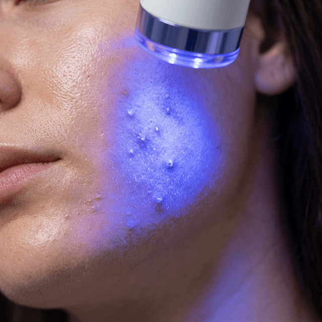 LED Face Mask for Acne: Which Wavelengths Actually Help and How to Use Them