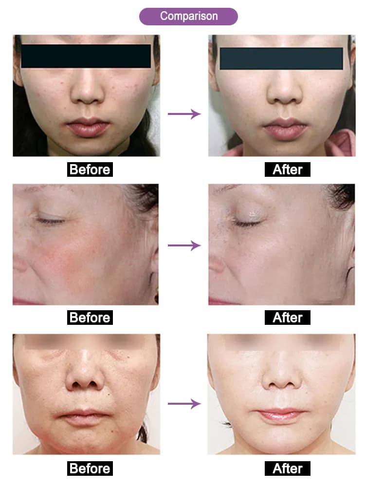 Skin Rejuvenation Red Light Therapy LED Face Mask — 4-Color detail 5